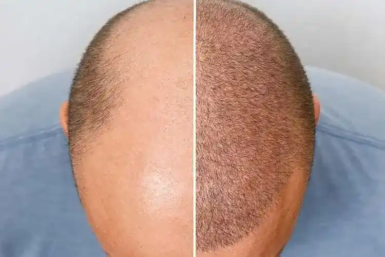 Hair Transplant in lucknow provided by The Velvet Skin Centre, Dermatologist in Lucknow, Skin Specialist in Lucknow