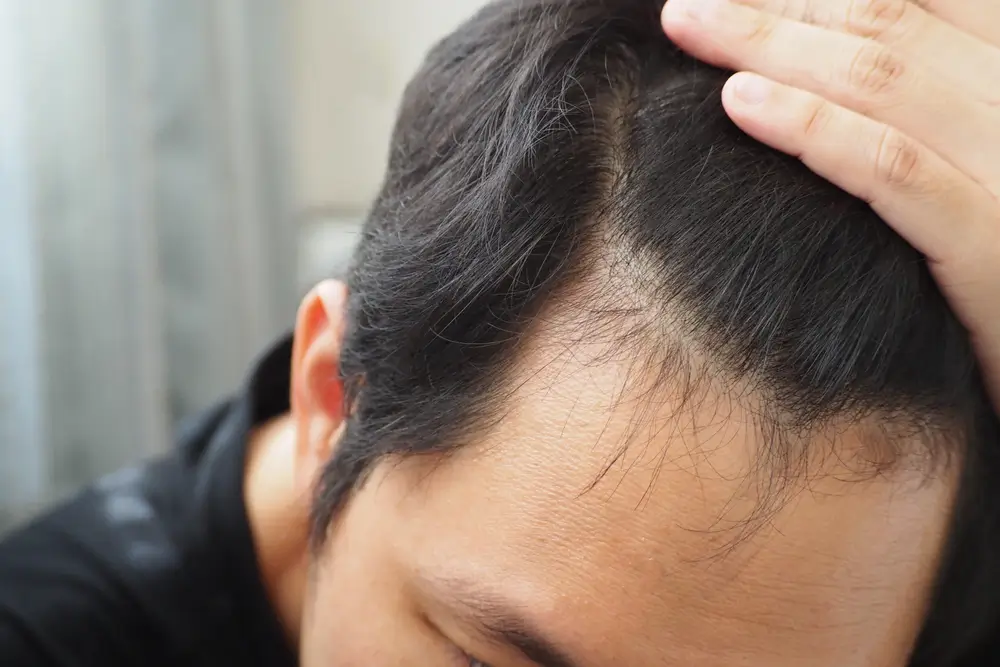 Hair Fall Treatment in Men