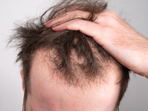 Best hair fall treatment in Lucknow Provided by Dr. Asma Dermatologist of The Velvet Skin Centre Lucknow
