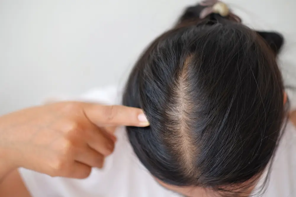 Hair Fall Treatment in Lucknow for Women : Cause, Treatment & Prevention