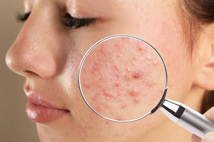 Best Acne Treatment Provided by Dr. Asma Dermatologist of The Velvet Skin Centre Lucknow