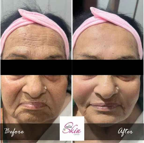 Anti Ageing Treatment using Filler Treatment in Lucknow, where the results are outstanding.