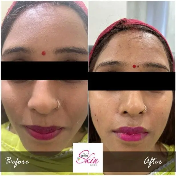 Filler Treatment in Lucknow done at The Velvet Skin Centre (Dermatologist in Lucknow) using Juvederm Filler's & Get Best Results.