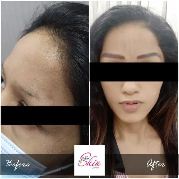 Microblading or Permanent Makeup for both eyebrows where the patient doesn't have sufficient brows, The Velvet Skin Centre, Skin Specialist in Lucknow, has provided results to a patient with good-looking eyebrows