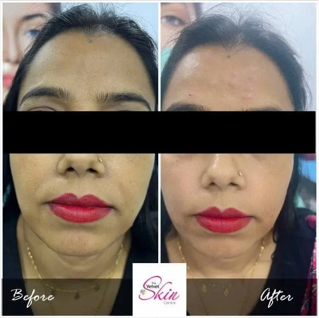 Filler Treatment for Nasobial Fold done to increase collagen at The Velvet Skin Centre Best Dermatologist in Lucknow provided results to achieve good looking face using Filler Treatment in Lucknow.