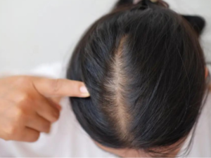 hairfall treatment in lucknow by Dr Asma The velvet Skin Centre