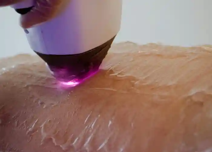 laser hair removal
