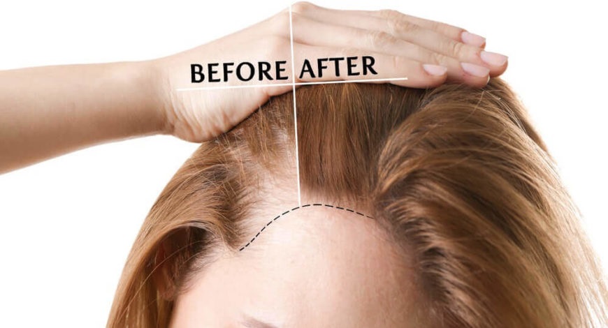 Hair Fall Treatment in Lucknow