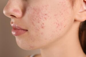 acne treatment in lucknow