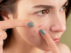acne treatment in lucknow