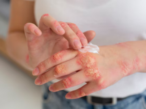 eczema treatment in lucknow