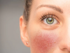 rocasea treatment in lucknow