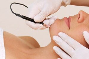 laser hair removal lucknow