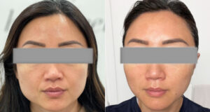 threadlift treatment in lucknow