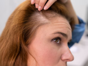 hair fall treatment in lucknow