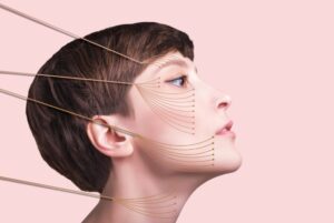 threadlift treatment in lucknow
