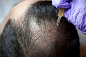 prp hair treatment in Lucknow
