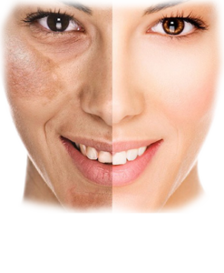 skin pigmentation removal treatment in lucknow