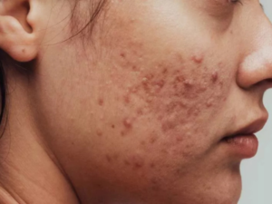 acne treatment in lucknow