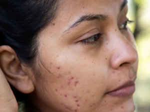 acne scar treatment in lucknow