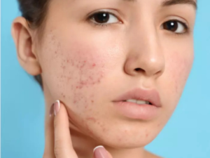 Acne Scar Treatment in Lucknow