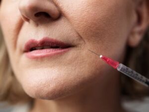 Dermal Fillers Treatment in Lucknow