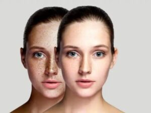 Pigmentation Treatment in Lucknow