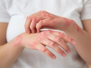 Psoriasis Treatment in Lucknow