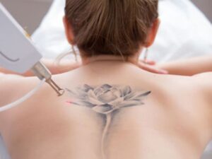 Tattoo Removal in Lucknow