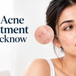 Best Acne Treatment in Lucknow