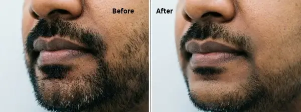 Before-and-after-laser-hair-reduction.