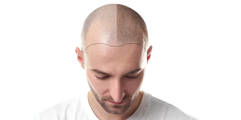 Hair Transplant Treatment in Lucknow Skin Doctor, Skin Clinic in Lucknow