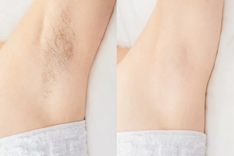 Its Time to Know all about Laser Hair Removal