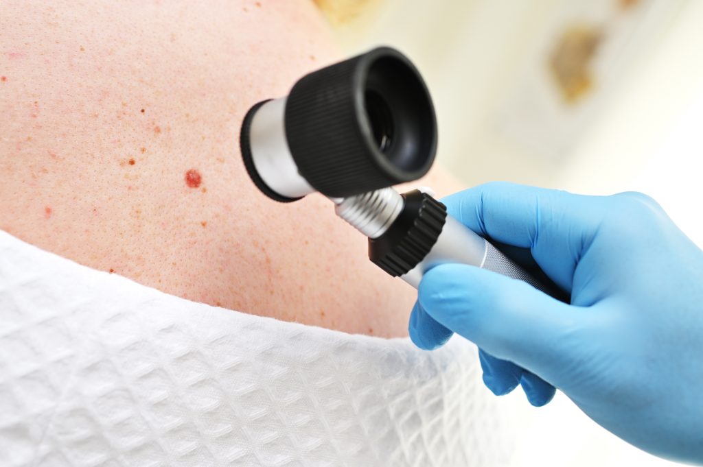 Melanoma Treatment in Lucknow : Cause, Treatment & Prevention – The ...
