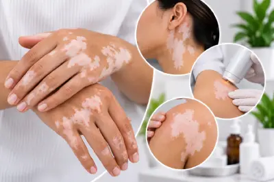 Vitiligo Treatment